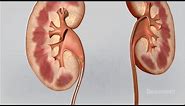 Kidney Stones Symptoms and Treatments