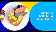 Deciphering STEMI vs. NSTEMI on ECG: A Comprehensive Visual Guide