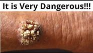 🔥 It is very dangerous!!! Warts - symptoms, treatment, prevention