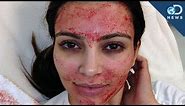 Kim Kardashian's Blood Facial