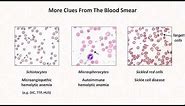 Anemia: Lesson 4 - Clues from the blood smear