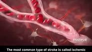 🩸🧠 Ischemic Strokes: Thrombotic vs. Embolic 🧠🩸 Let's shed light on Ischemic Strokes, two different types: Thrombotic and Embolic. Knowing the difference can be crucial in understanding stroke risks and prevention. 🔍 Thrombotic Stroke: This type of stroke occurs when a blood clot (thrombus) forms within one of the brain's blood vessels, often due to the buildup of fatty deposits in the arteries (atherosclerosis). The clot blocks blood flow, leading to an ischemic stroke. 🚫 Embolic Stroke: A