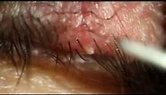 Pus from Eyelash Infection