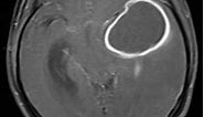 Cerebral ring enhancing lesions | Radiology Reference Article | Radiopaedia.org