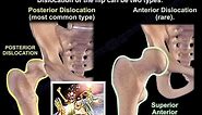 Dislocation of the hip - Everything You Need To Know - Dr. Nabil Ebraheim