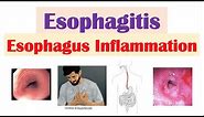 Esophagitis (Esophagus Inflammation): Causes, Risk Factors, Signs and Symptoms, Diagnosis, Treatment