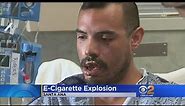 Tustin Man Recovering After E-Cig Explodes In His Mouth