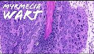 Myrmecia Wart (plantar wart under the microscope, verruca, palmar wart) pathology dermpath