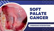 Soft Palate Cancer: 3 Promising Interventions