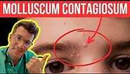 Doctor explains Molloscum Contagiosum (viral skin infection) | Causes, symptoms and treatment