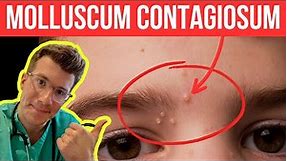 Doctor explains Molloscum Contagiosum (viral skin infection) | Causes, symptoms and treatment
