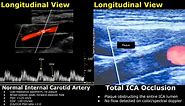 Carotid Artery Color/Spectral Doppler Ultrasound Normal Vs Abnormal Images | ICA Stenosis USG