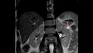 What does a kidney cyst look like on MRI?