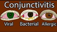 Pink Eye (Conjunctivitis) - Viral, Bacterial and allergic conjunctivitis. Symptoms and treatment