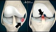 Is your knee pain coming from an ACL tear or Meniscus injury? How to tell.