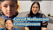 How we cured/treated molluscum contagiosum update 2021 ! How to get rid of molluscum contagiosum