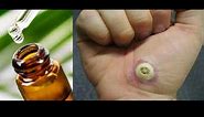 WART REMOVAL ESSENTIAL OIL: I've found only this essential oil that will actually GET RID OF WARTS