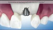 Repair Of Failing Dental Implant
