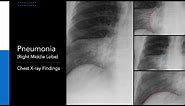 Pneumonia (Right Middle Lobe): Explanation of Chest X-ray Findings