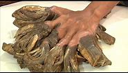 Bangladeshi man with tree-like growth on hands undergoes first corrective surgery