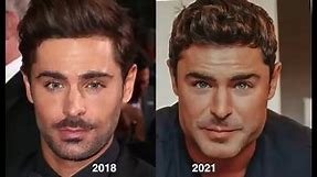 Zac Efron Gets a NEW Face: DENIES Plastic Surgery!