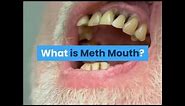 What is Meth Mouth?
