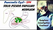 Solid Pseudopapillary Neoplasm Pancreas (SPN)