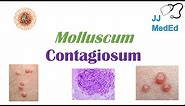 Molluscum Contagiosum (“Papules with Belly Buttons”): Risk factors, Symptoms, Diagnosis, Treatment