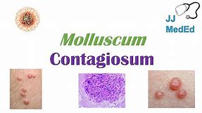 Molluscum Contagiosum (“Papules with Belly Buttons”): Risk factors, Symptoms, Diagnosis, Treatment