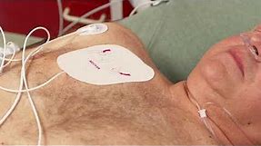 Non-Invasive Transcutaneous Pacing with the HeartStart Intrepid monitor/defibrillator