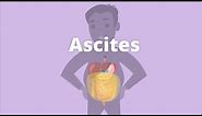 Cirrhosis – Ascites and pleural effusion