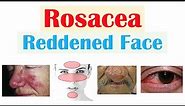 Rosacea (Red Lesions on Face) | Causes, Triggers, Types, Signs & Symptoms, Diagnosis, Treatment