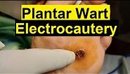 Treatment of Viral Warts - Electrocautery Procedure