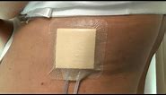 How to care for a post-surgery wound drainage system and Mepilex dressing