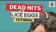 Dead Nits vs Live Lice Eggs Video Tutorial