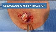 Sebaceous Cyst Extraction | CONTOUR DERMATOLOGY