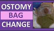 Ostomy Bag Pouch Change | Ostomy Care Nursing | Colostomy, Ileostomy Bag Change