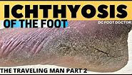 Ichthyosis of the Foot: Travelin' Man's Severe Skin Condition and Treatment