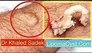 Large Leg Cyst. Dr Khaled Sadek. LipomaCyst.com