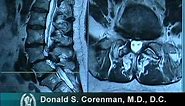 How to Read a MRI of Lumbar Degenerative Spondylolisthesis and Spinal Stenosis