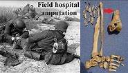 Sawbones 1945 - Archeological evidence of first aid and emergency surgery on WWII German soldiers