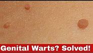 Your Guide to Freedom: How to Get Rid of Genital Warts FAST!
