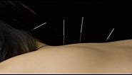How does Acupuncture work? Alberta College of Acupuncture & Traditional Chinese Medicine, Calgary