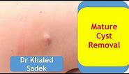 Sebaceous cyst removal. Dr Khaled Sadek. London Cyst Clinic