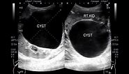 Ultrasound Video showing a large Renal Cyst.
