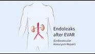 Endoleaks after Endovascular Repair of Thoracic Aortic Aneurysms (EVAR)