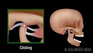 Temporomandibular Joint (TMJ) Anatomy and Disc Displacement Animation