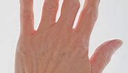An Overview of Finger Arthritis