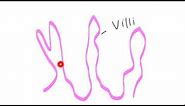 Colonic polyps and Colon Adenomas ; Pathology