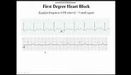 prolonged PR interval ( 1st degree HB )